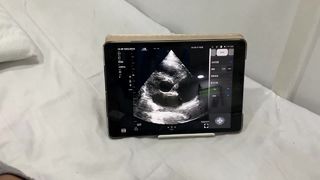 Sonda de ultrassom sem fio de cabeça dupla para cardíaco e POCUS