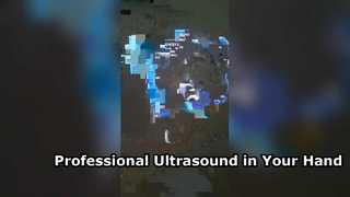Ultrassom transvaginal portátil para ginecologia moderna