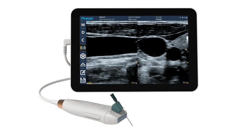 Scanner de ultra-som portátil com sonda linear de alta frequência de 12 MHz para procedimentos precisos de acesso vascular e inserção de PICC